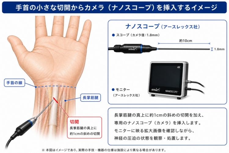 鏡視下手根管開放術